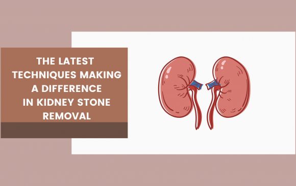The Latest Techniques Making a Difference in Kidney Stone Removal